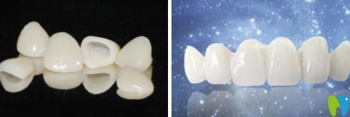 網(wǎng)上說做了全瓷牙好后悔是真的嗎?來聽聽做全瓷牙人的經(jīng)歷