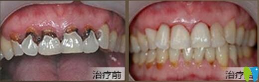 北京中諾口腔好不好？郭祖迎牙齒修復(fù)案例效果來驗證