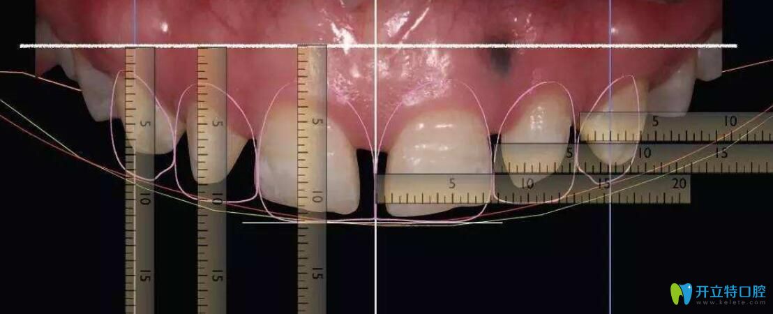 為什么要做牙冠延長術？揭秘做牙冠延長術后悔死了的真相