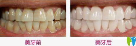 杭州美奧口腔牙齒冷光美白案例