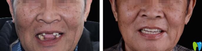 青島種植牙哪家比較好？維樂口腔梁騰種植牙案例來證明