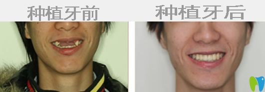 種植牙前后對比圖