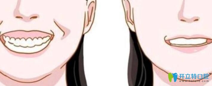 那么為什么有些人做牙冠延長術(shù)后悔死了呢