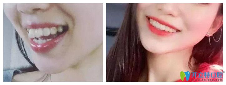 牙齒矯正能改變臉型嗎？看維樂口腔<!--<i data=20240703-sp></i>-->齙牙矯正前后對比圖