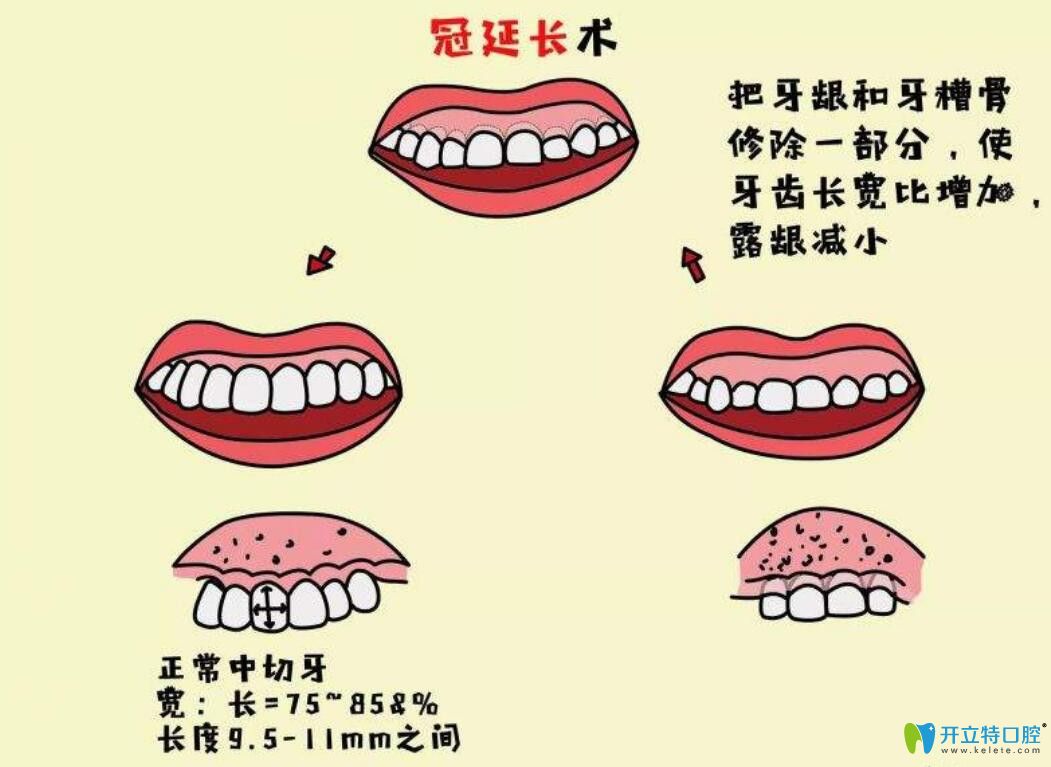 牙冠延長術(shù)是什么，有什么作用