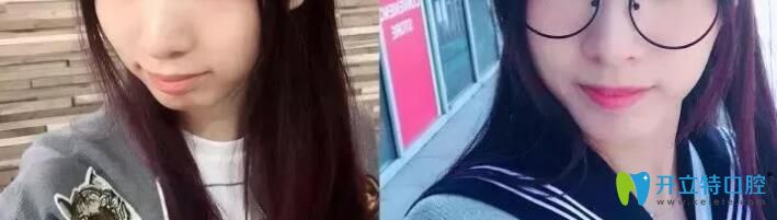青島維樂口腔梁騰怎么樣？牙齒矯正案例效果來揭曉