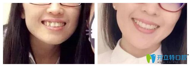 青島維樂口腔<!--<i data=20240703-sp></i>-->牙齒矯正怎么樣？案例效果來驗證