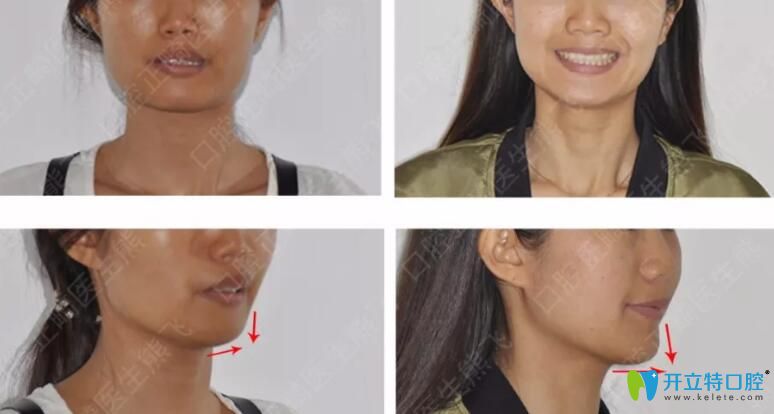 廣州圣貝口腔怎么樣？公布熊飛等醫(yī)生牙齒矯正案例