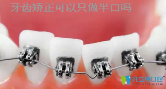 牙齒可以只矯正半口嗎？為什么醫(yī)生不建議只做半口矯正？
