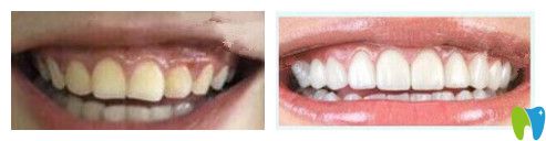 中諾口腔鄭宏光牙齒瓷貼面美容修復(fù)案例