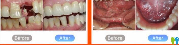 北京中諾口腔鄭宏光種植牙怎么樣？真人案例來揭曉