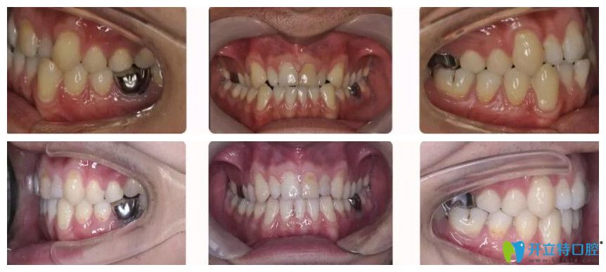 福州哪里整牙比較好？看福州維樂口腔郭淑蘋地包天矯正案例效果圖