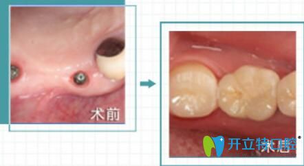 福州哪家種植牙好？維樂口腔陳獻(xiàn)禮院長(zhǎng)即刻種植案例來驗(yàn)證