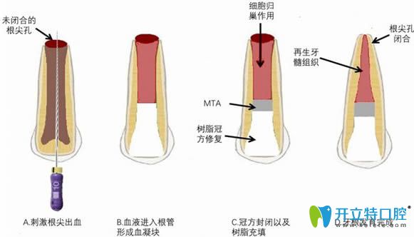 牙髓血管再生術(shù)治療過程圖解