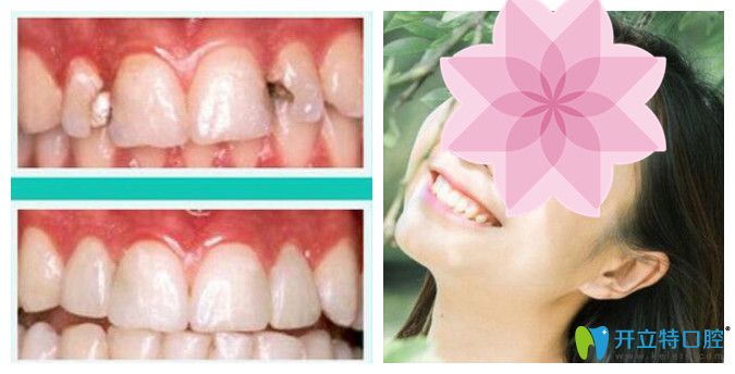 北京中諾口腔張勝民牙齒修復(fù)怎么樣？真實(shí)案例效果公布