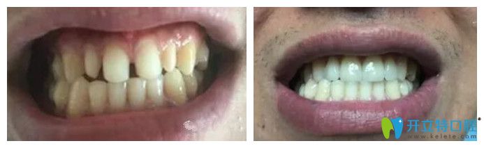 北京中諾口腔劉曉清怎么樣？來看瓷貼面修復牙齒案例效果