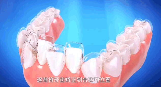 重慶成佳牙博士好不好呢，牙齒矯正效果來(lái)預(yù)見(jiàn)