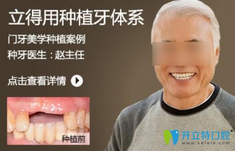 北京中諾趙振宇種植牙怎么樣？案例及顧客反饋來看