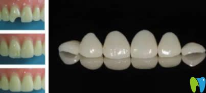 千萬(wàn)別做樹(shù)脂牙齒貼面的真相,看樹(shù)脂牙齒貼面價(jià)格及優(yōu)缺點(diǎn)