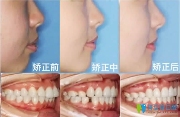 洛陽(yáng)拜博隱適美齙牙矯正后臉型變化對(duì)比圖