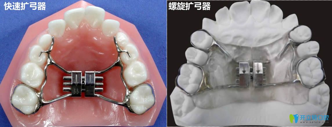 揭開牙齒擴弓后非常后悔的真相 其實拔牙和擴弓各有利弊