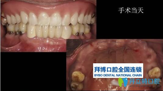 楊小林醫(yī)生無牙頜種植病例前后對(duì)比效果