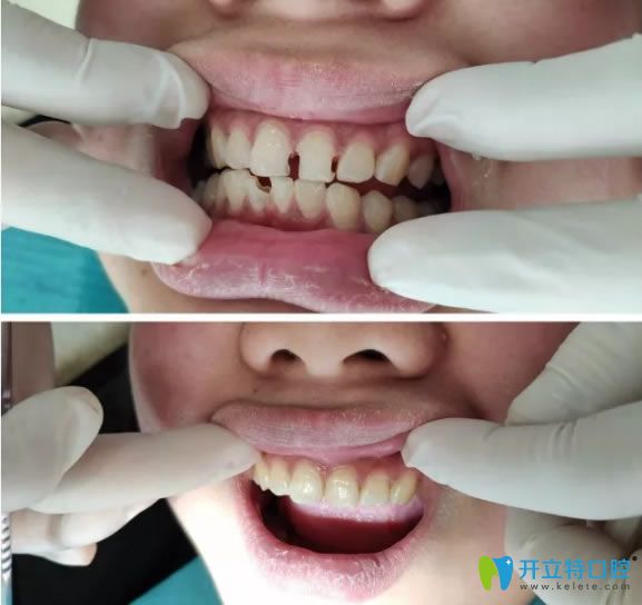 洛陽拜博口腔謝良雄醫(yī)生治療案例前后對比圖 洛陽拜博口腔謝良雄醫(yī)生治療案例前后對比圖