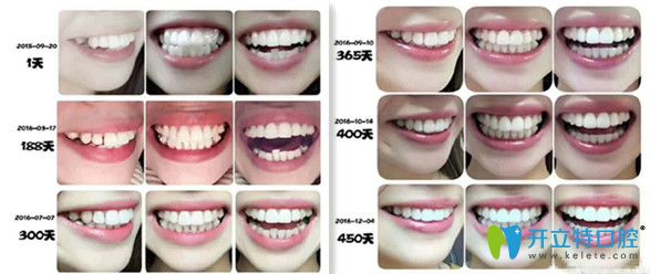 帶牙套牙齒變化過程圖