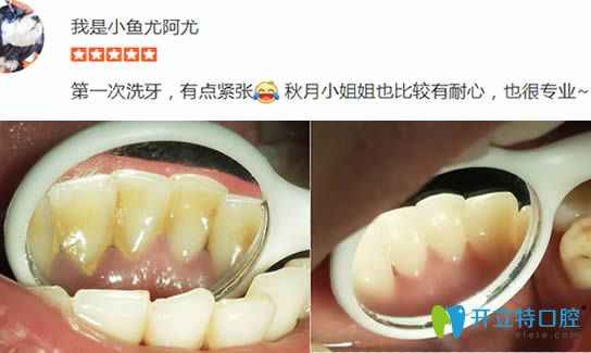 顧客在洛陽(yáng)拜博洗牙前后對(duì)比效果圖 顧客在洛陽(yáng)拜博洗牙前后對(duì)比效果圖