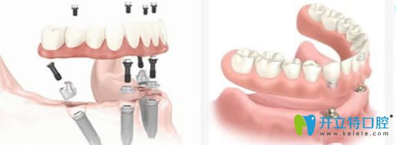湛江致美口腔ALL-ON-4種植牙技術