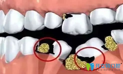 牙齒缺失時間長不補會怎么樣