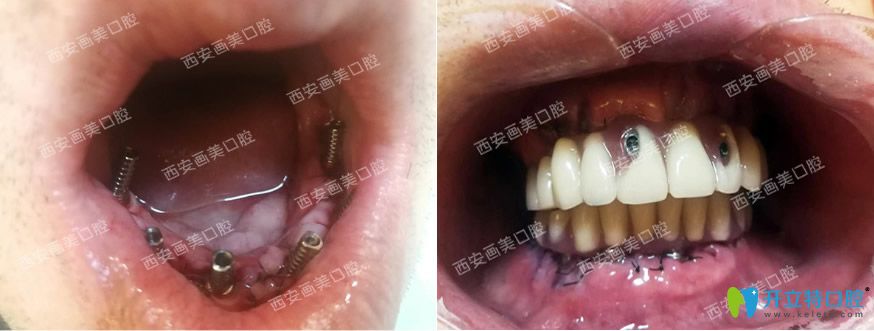 全口種植牙對比前后