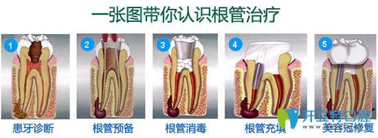 廊坊愛嘉口腔李恩基醫(yī)生介紹根管治療 廊坊愛嘉口腔李恩基醫(yī)生介紹根管治療