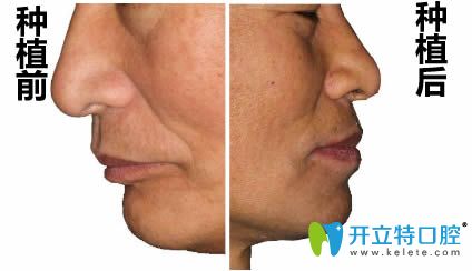 在洛陽拜博做完即刻種植牙前后對比照