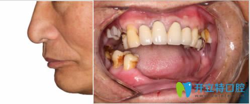 我去洛陽(yáng)拜博做即刻種植牙已經(jīng)1年了,分享下個(gè)人經(jīng)歷及感受