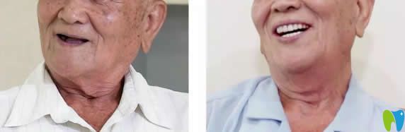 顧客吐槽在湛江致美口腔做的全口種植牙價格不貴效果滿意