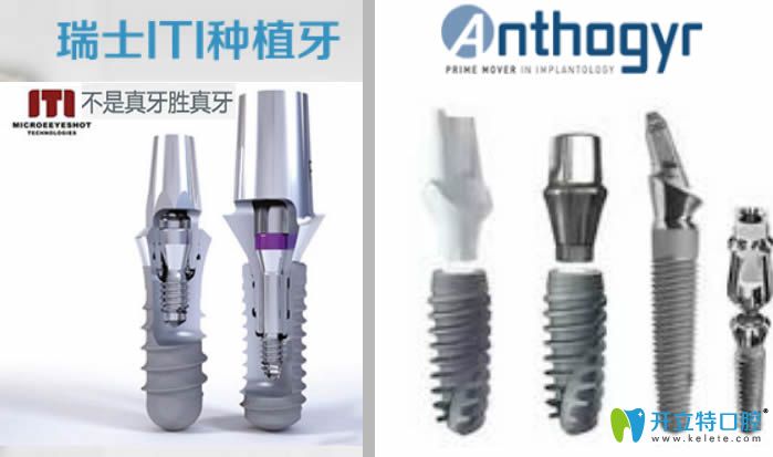 解析法國安卓健和瑞士iti哪個(gè)好?奉上iti和Anthogyr種植體價(jià)格