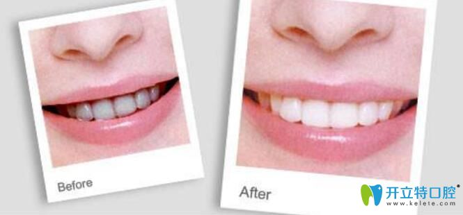 牙齒噴砂和拋光區(qū)別是什么，哪個(gè)好