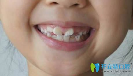 小孩新?lián)Q的恒牙長歪了怎么辦?恒牙長歪會自動調整歸位嗎?