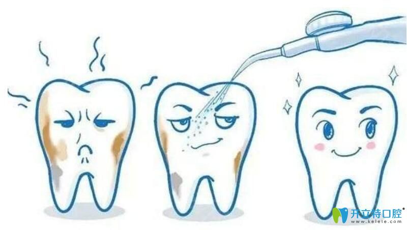 洗牙時(shí)噴砂就是拋光嗎