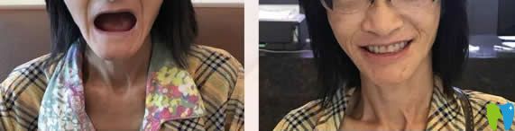 湛江致美口腔全口種植牙案例圖