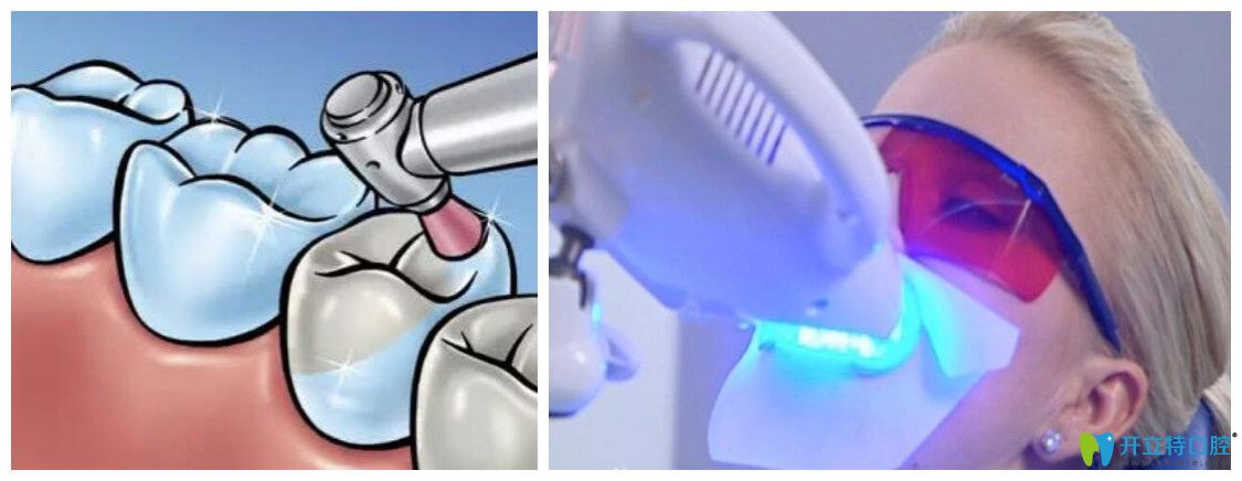 牙齒噴砂和拋光是什么