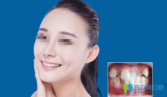 重慶牙科哪家正畸好點？來看華美口腔牙齒不齊歪斜矯正案例