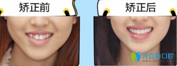 26歲顧客隱適美隱形矯正前后對(duì)比照