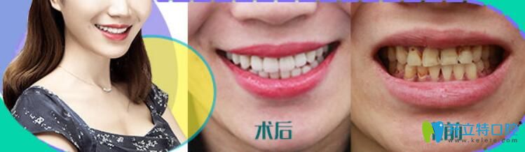 瓷貼面做了后悔死了，后悔沒有早點選擇華美牙科修復我的四環(huán)素牙