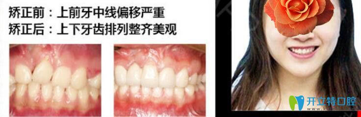 重慶華美口腔前牙中線偏移嚴重矯正案例