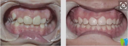 周驊醫(yī)生成人時(shí)代天使隱形矯正前后對比效果 周驊醫(yī)生成人時(shí)代天使隱形矯正前后對比效果