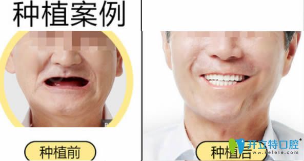 <!--<i data=20240703-sp></i>-->宏康李敬主任全口種植牙前后對(duì)比效果圖 <!--<i data=20240703-sp></i>-->宏康李敬主任全口種植牙前后對(duì)比效果圖