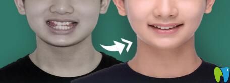 重慶華美口腔丁愛軍怎么樣？真人案例來驗證