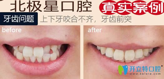 無錫北極星口腔牙齒正畸案例效果對比圖 無錫北極星口腔牙齒正畸案例效果對比圖